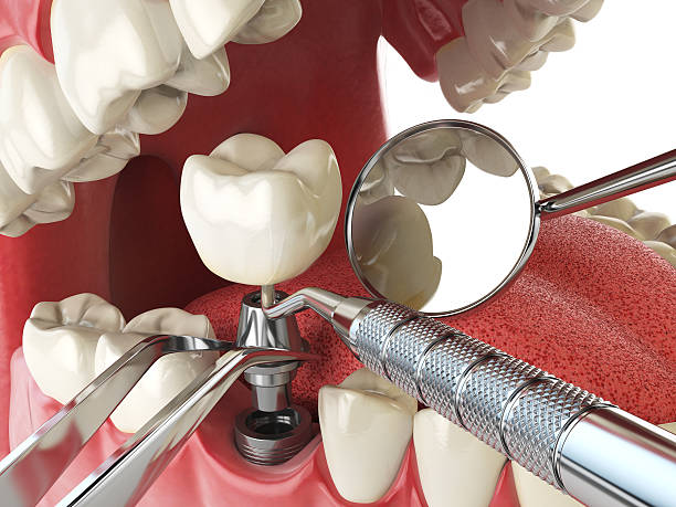 Best Emergency Broken Tooth Repair in Juniper Canyon, OR