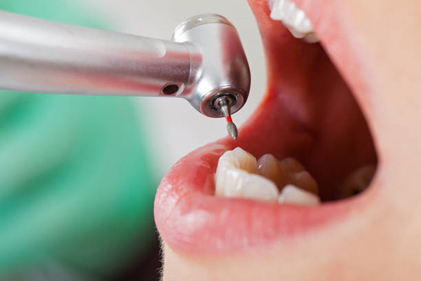 Best Emergency Tooth Extraction in Juniper Canyon, OR